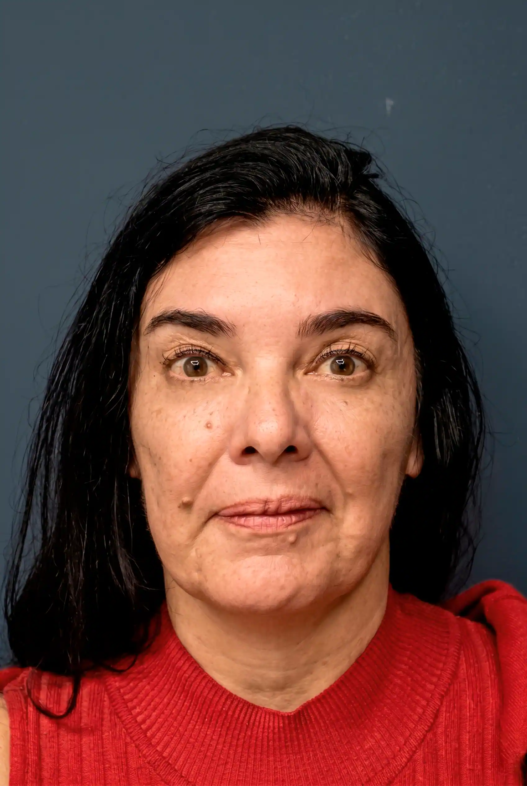 Karin — depois do tratamento